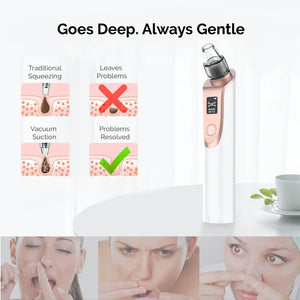 Clear Skin Vacuum Blackhead Remover & Pore Cleaner | Facial Acne & Pimple Removal Tool | Great For At-Home Spa Treatment & Healthcare | Unisex Male Female | Perfect for Adults & Youth.